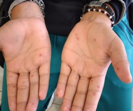 Atiende SSO ocho brotes por virus Coxsackie en la entidad